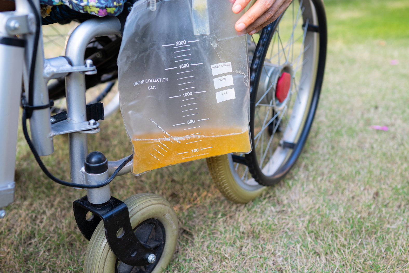 Asian Lady Patient Sitting on Wheelchair with Urine Catheter Dra